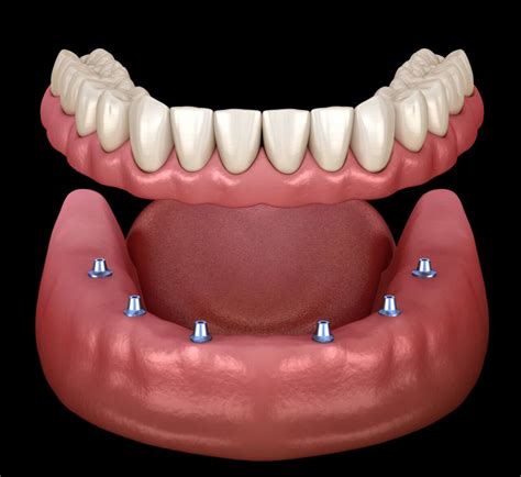 Implant Supported Dentures: All you need to know | bellevuerx.com