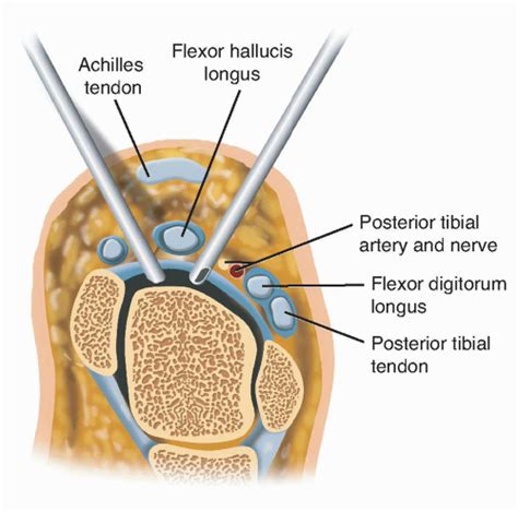 Arthroscopy of the Ankle | Musculoskeletal Key