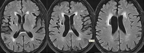 The Role of MRI and DaTscan in Vascular Parkinsonism: A Case Report ...