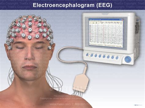 Electroencephalogram (EEG) - TrialQuest Inc.