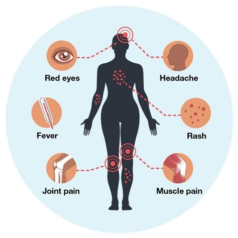 Zika Virus Disease: What Are The Causes, Symptoms and Treatment of This Mosquito-Borne Illness ...