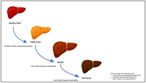 Progression of non-alcoholic fatty liver disease (NAFLD). The stages of ...