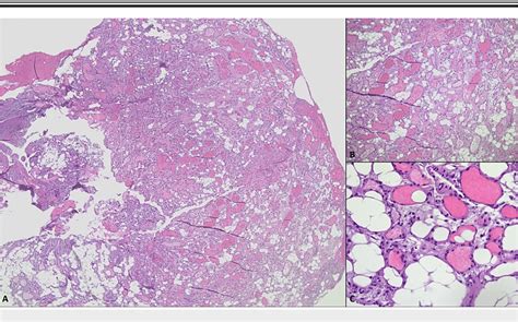 [PDF] A Case of Thoracic Epidural Angiolipoma Causing Severe Spinal ...