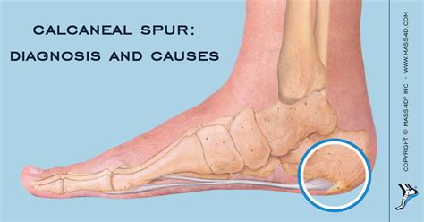 Plantar Calcaneal Spur Treatment