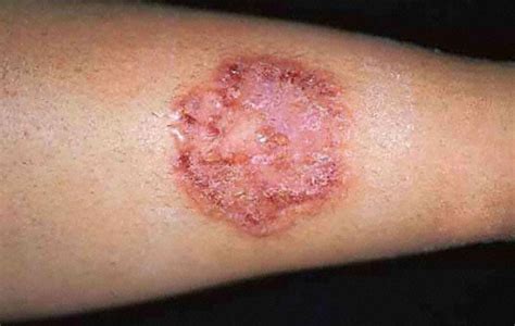 What are the Symptoms of Ringworm?