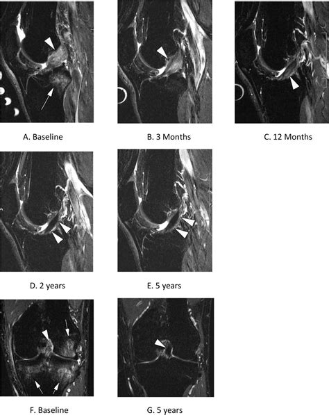 Mri Knee Acl Tear