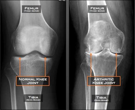 Osteoarthritis - Causes, Symptoms, Diagnosis, Prognosis & Treatment