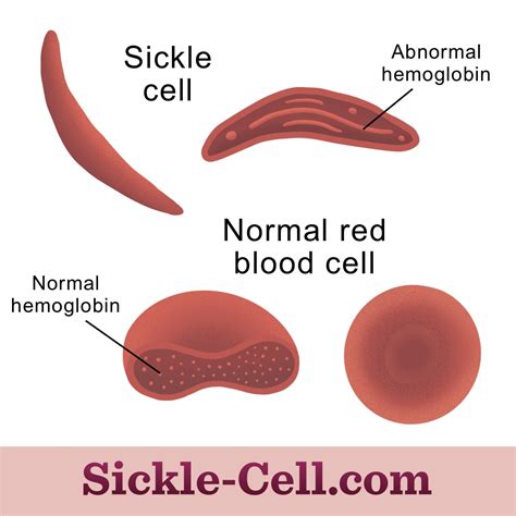 Hemoglobin Mutations Cause Sickle Cell Disease