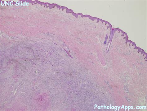 epithelioid sarcoma pathology