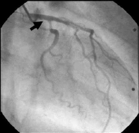 Coronary angiography in the right anterior oblique position with a left... | Download Scientific ...