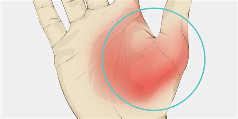 Sprained Thumb - The Complete Injury Guide - Vive Health