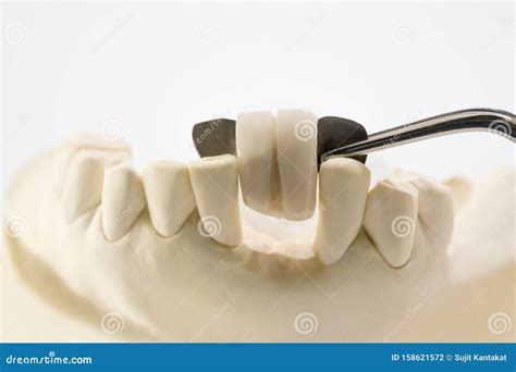 Dental Maryland Bridge. Stock Image | CartoonDealer.com #194913739