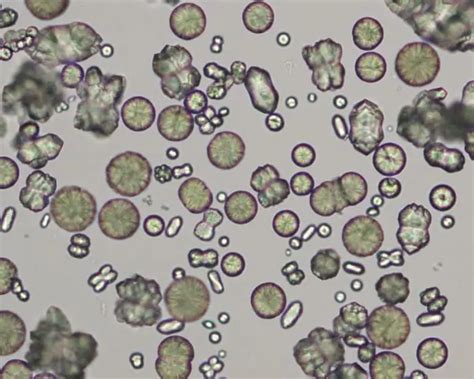 Amorphous crystals in urine: features, interpretation and indicators | Medicine 2024