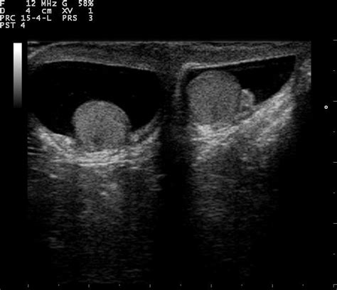 Ultrasound Imaging of Scrotum