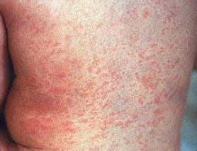 Yakov G. Bogatin & Medical Issues | Jacob Bogatin: Treatment of German measles