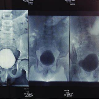 Bladder diverticulum. | Download Scientific Diagram