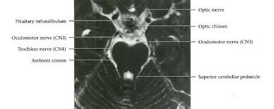 Dr Balaji Anvekar FRCR: Cranial Nerves Normal MRI Anatomy