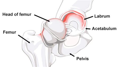Labral Tear of the Hip Joint – An Tâm