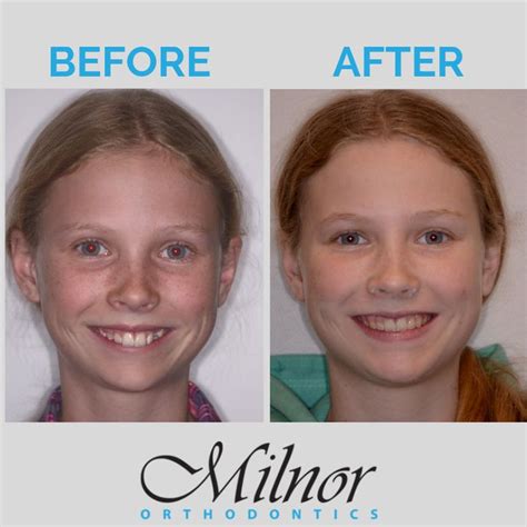 Braces Before and After | Orthodontics, Invisalign, Orthodontics braces