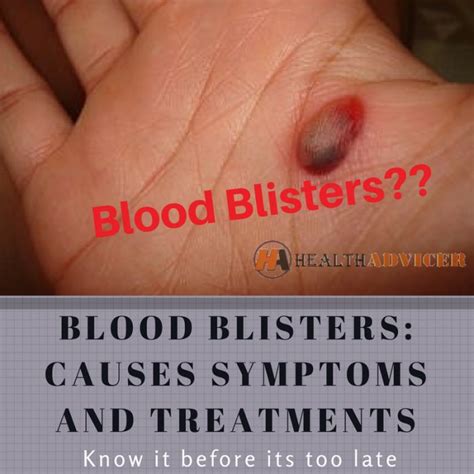 Blood Blisters : Causes, Symptoms, Treatment And Home Remedies