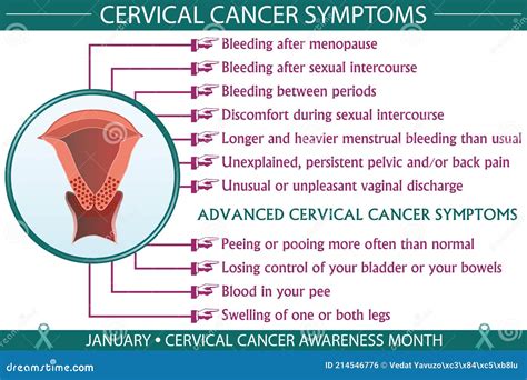 Cervical Cancer Symptoms Infographic Vector Illustration Stock Vector ...