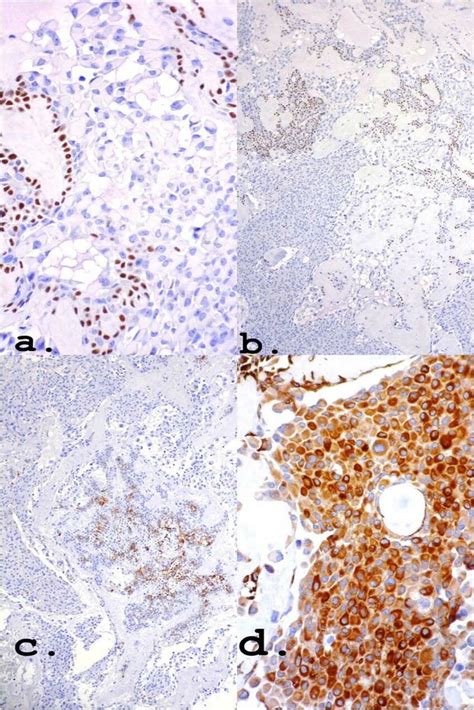 Own nuclear marker of myoepithelial cells (a) and (b): p63 ×40 and ×10 ...