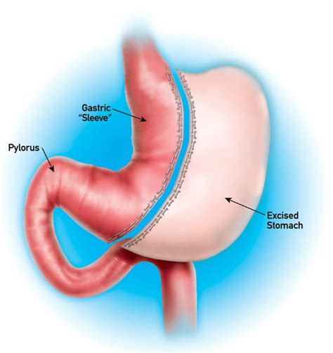 Sleeve Gastrectomy San Diego, Gastric Sleeve Procedure San Diego