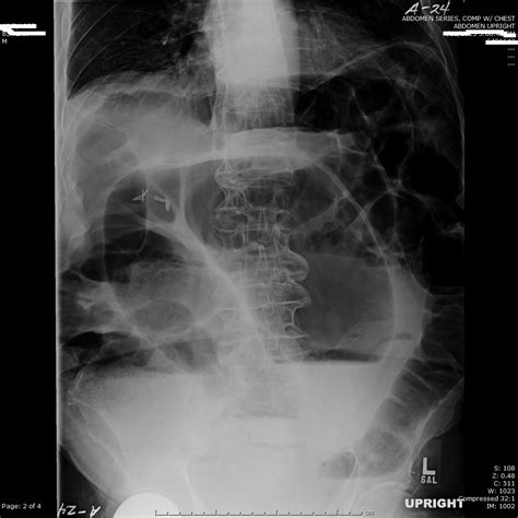 Colon Volvulus Sigmoid 2216 Uph Sig Volv | Surgery Photos