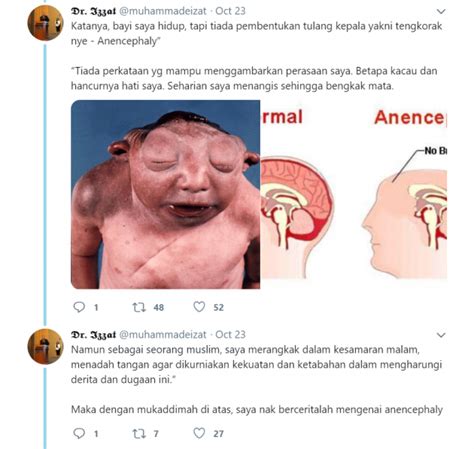 Anencephaly, Kecacatan Dihidapi Bayi Dalam Kandungan