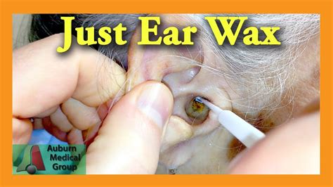 Ear Wax Removal Doctor | Auburn Medical Group - YouTube