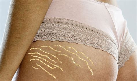 Stretch Marks: Causes, Treatment, And Prevention | Skincare.com