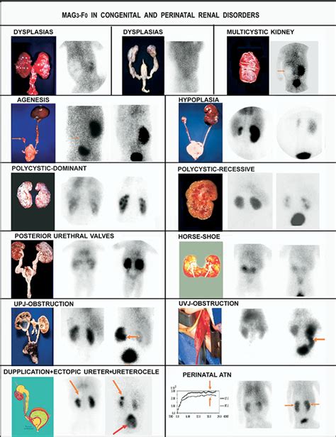 Renal Diseases