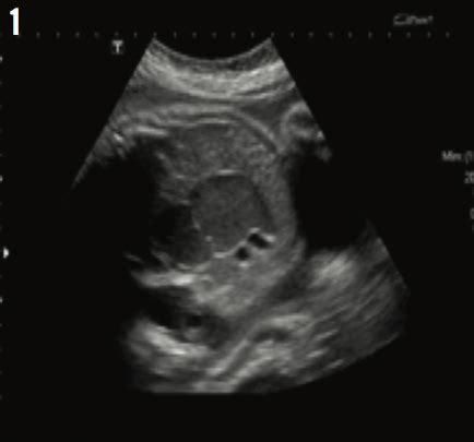 Bowel Obstruction Associated With Fetal Echogenic Distended Bowel Loop | Consultant360