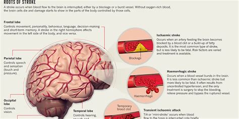 Mini Strokes Can Leave Long Lasting Damage to the Brain