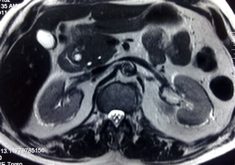 Groove Pancreatitis-MR & CT - Sumer's Radiology Blog