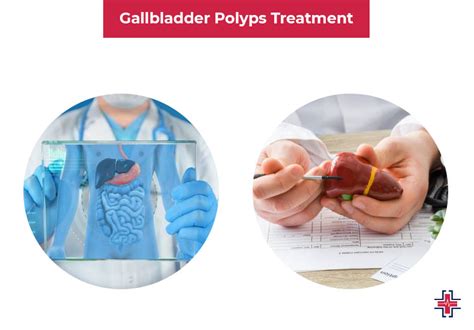 Gallbladder Polyps: Symptoms, Causes, Types, and Treatment | ER of Mesquite