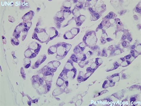 signet ring cell carcinoma pathology