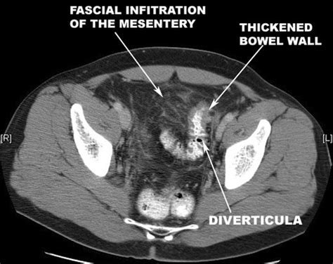 Diverticulosis / Diverticulitis