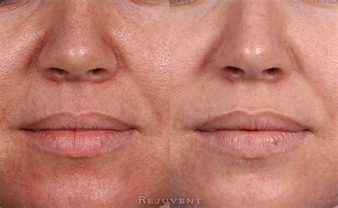 Pore Reduction Photos • Rejuvent Medical Spa Scottsdale