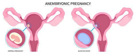 Blighted Ovum: Causes, Symptoms & Treatment