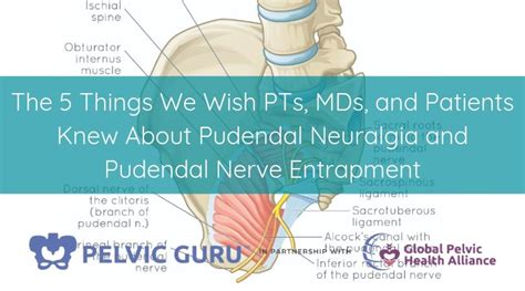 Pudendal Neuralgia Archives | Pelvic Guru