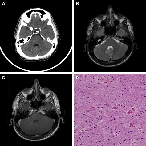 Posterior Fossa Tumor Causes Symptoms Treatment | SexiezPicz Web Porn