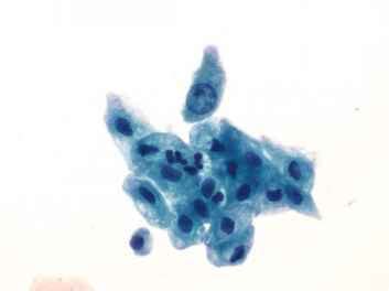 Atypical Urothelial Cells Indeterminate for Neoplasia - Urothelial Cells