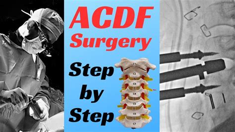 Cervical fusion (ACDF) surgery: Step-by-step - YouTube