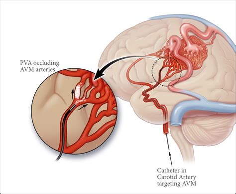 Arteriovenous Malformation (AVM) | Fundamentals of nursing, Nursing ...