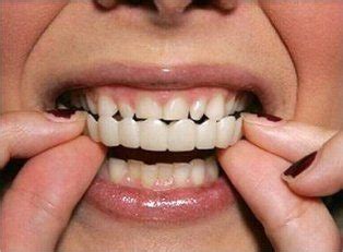 Snap-on Smile | Cosmetic Dentistry