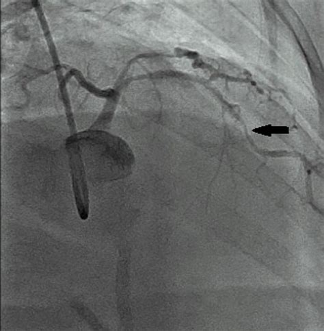 Cureus | Successful Management of Coronary In-Stent Restenosis: A Case ...