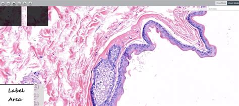 Steatocystoma Multiplex Histology