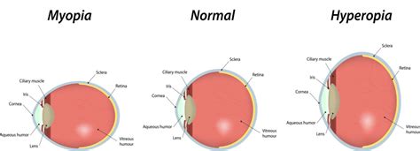 Monovision LASIK (How it Works, Ideal Candidates & FAQs)