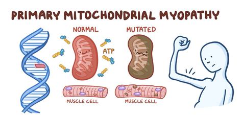 Mitochondrial myopathy: Video, Anatomy & Definition | Osmosis